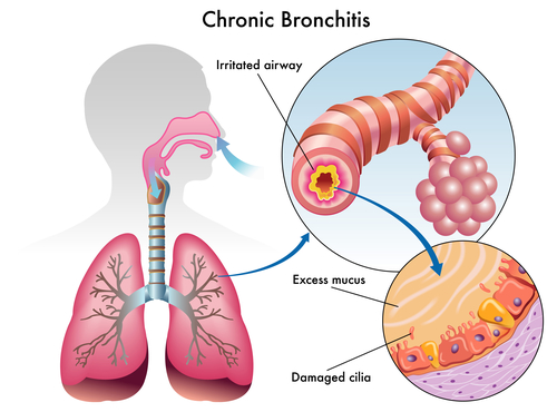 Smoking and Chronic Lung Disease: What To Know