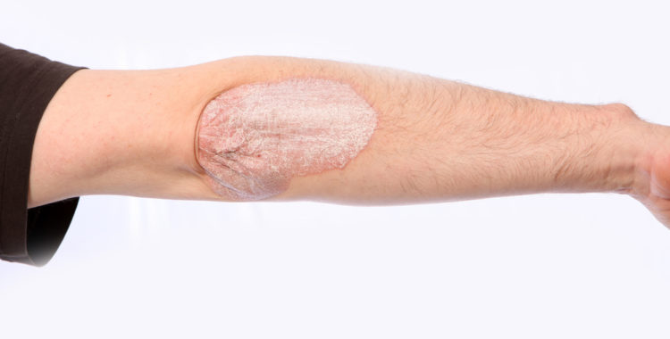 Learning About Psoriasis Causes, Symptoms, and Treatment