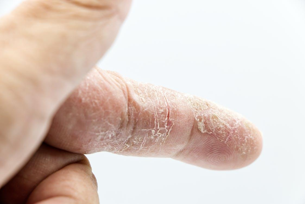 atopic eczema